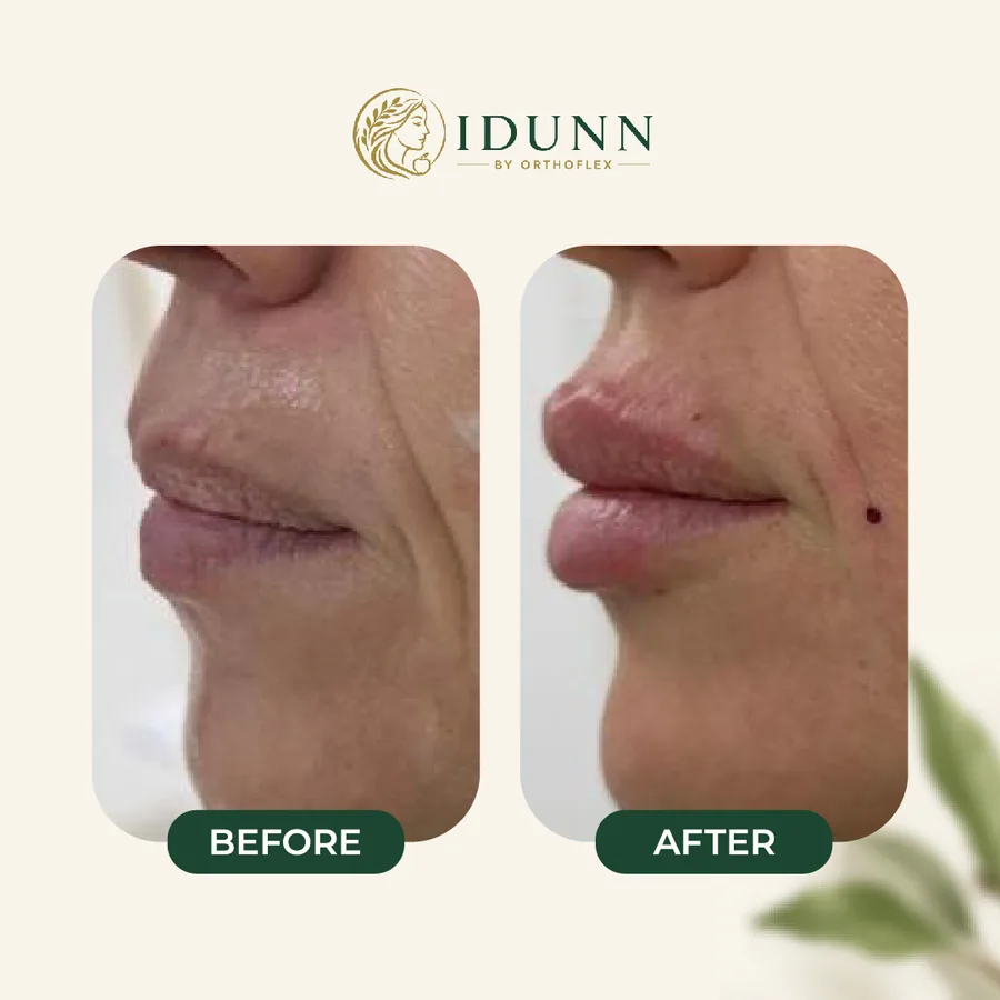 Before and after — Lips, profile, at the IDUNN clinic