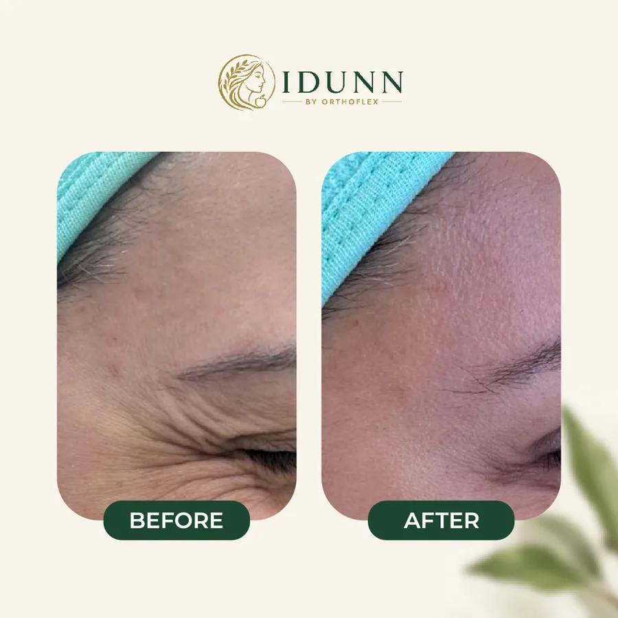 Before and after — Lines around the eye, at the IDUNN clinic