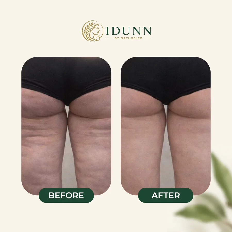 Before and after — Thighs, at the IDUNN clinic