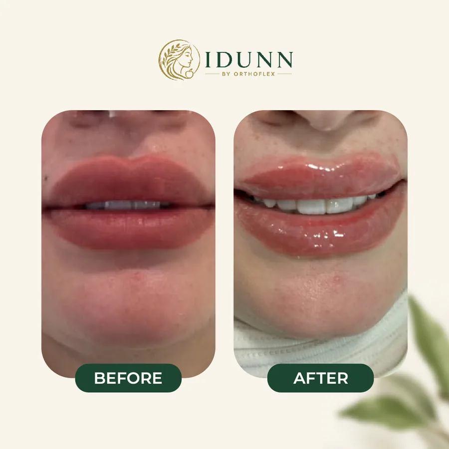 Before and after — Lips, at the IDUNN clinic